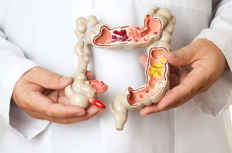 SC pode registrar quase 2,5 mil novos casos de câncer de intestino em 2023