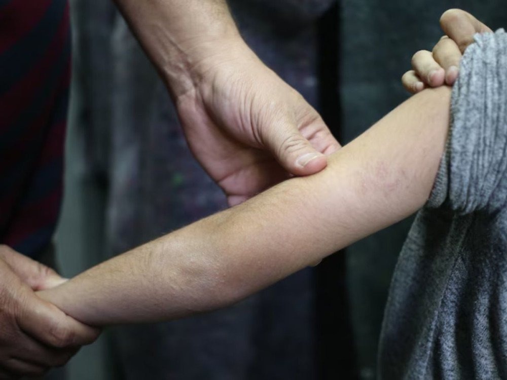 Balneário Camboriú notifica 43 casos de sarna; médico sanitarista explica possível associação com ivermectina