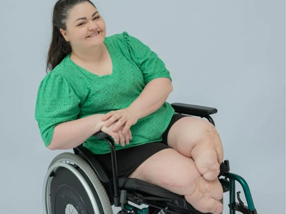 Blumenauense de 34 anos cria vaquinha para comprar próteses após fratura e negativa do INSS: “Quero voltar a andar”